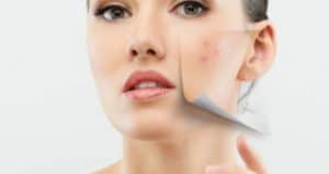 Cystic acne, how to get rid of severe acne forever