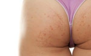 Butt pimples - how to get rid of them