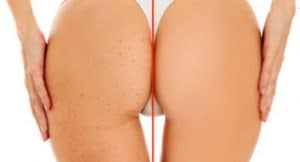 Butt pimples - how to get rid of them