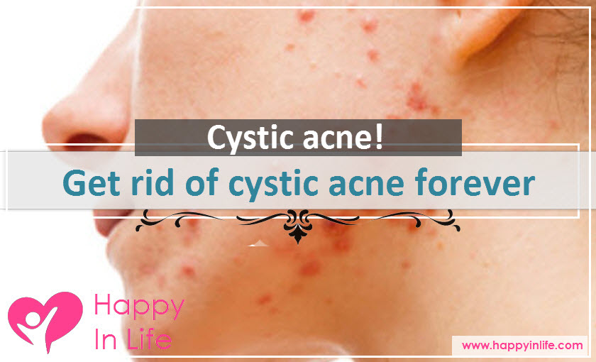 Get rid of cycstic acne