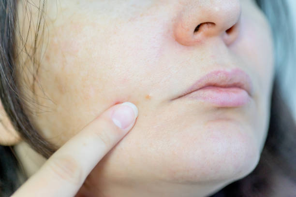  Does tretinoin help with acne scars