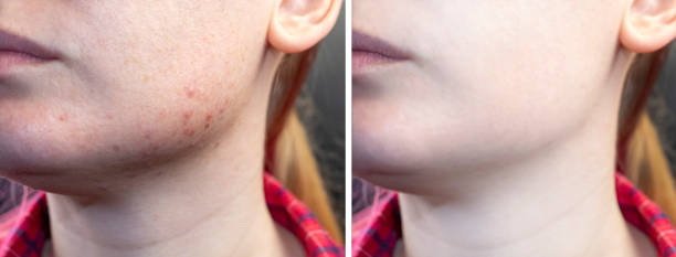  Does tretinoin help with acne scars